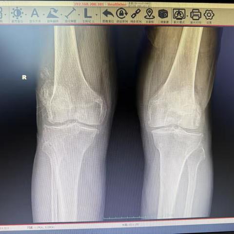 三十载膝痛缠身 丰荣精准施治——铜川丰荣医院成功为八旬老人实施全膝关节置换术