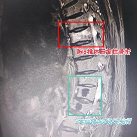 铜川丰荣医院脊柱关节科微创“修复”骨折椎体，患者术后次日轻松下床！