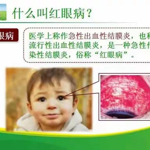 凯里市第十一小学急性出血性结膜炎知识宣传
