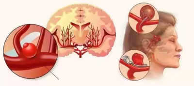 支架辅助弹簧圈栓塞破裂动脉瘤六例分享