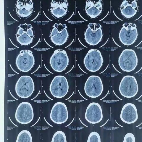 缪组79625-27床赵英军-颅内动脉瘤