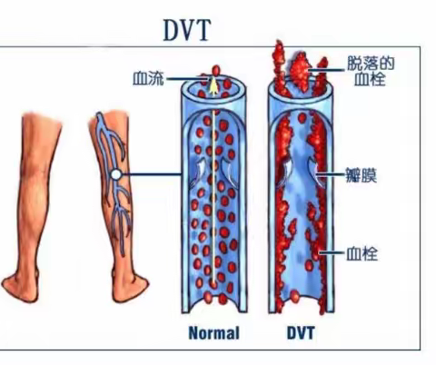 下肢深静脉血栓解析：探寻原因、症状与预防策略的实用指南