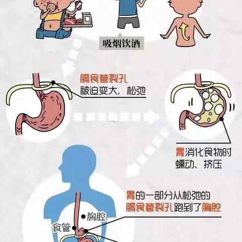 “胃”入非非：食管裂孔疝的奥秘与解密