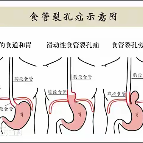 🍽️ 食管裂孔疝：胃“跑”到胸口？别忽视这场“隐形反流”
