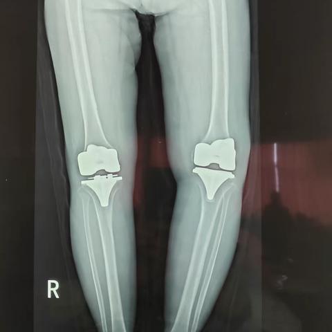 榆次区人民医院骨二科完成我院首例人工铰链膝置换术