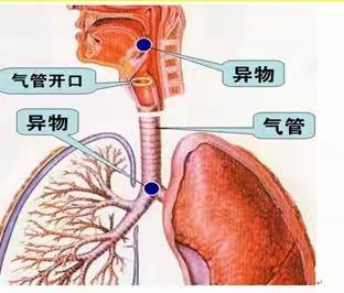 【健康全南 科普先行】气道异物梗阻危害大， 这些急救方法一定要掌握！