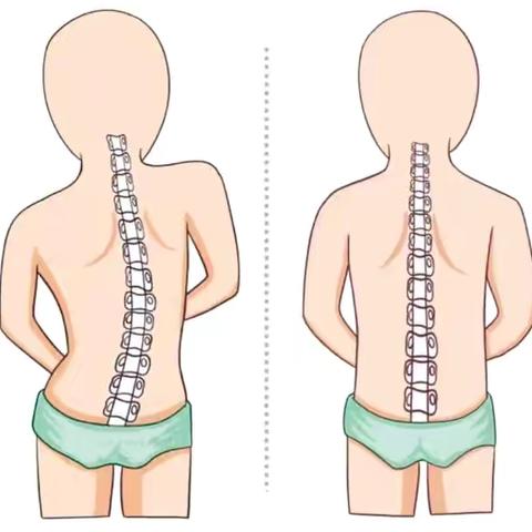 暑假儿童青少年特发性脊柱侧弯矫正训练营即将开营-林州市妇幼保健院