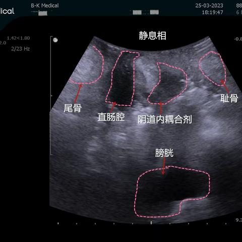 病例分享-经直肠超声（TRUS）在盆底功能障碍性疾病（PFD）及直肠肿物中的临床诊断价值