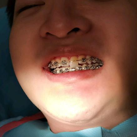 陆禹嘉牙终于整好了-2025年12月24号