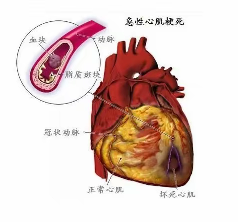 时间就是心肌  时间就是生命—双柏县大麦地卫生院再次溶栓成功1例急性心梗患者