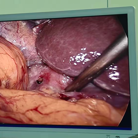 腹腔镜下消化道穿孔修补术成功救治高龄胃溃疡穿孔急诊患者