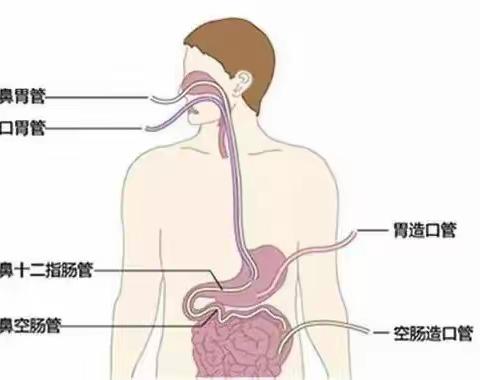 徒手盲插空肠管：ICU护士的巧妙技艺与患者的希望之光