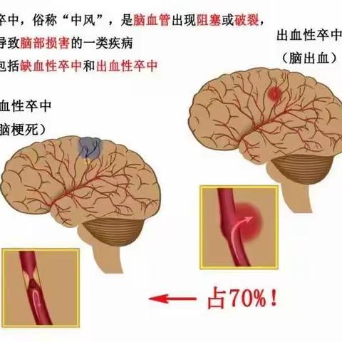 脑卒中患者的另一个春天