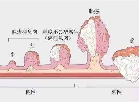 40岁之前无症状做一次肠镜，可以最大限度躲过肠癌