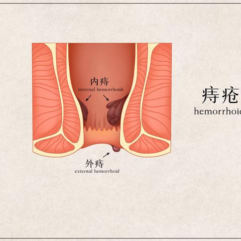 【沈阳中泰肛肠医院】痔疮会传染吗？为什么越长越多？