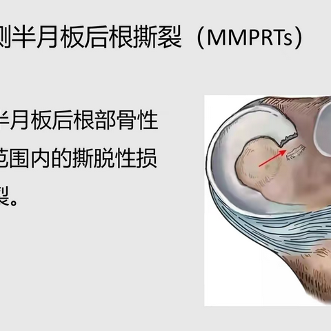 孜孜不倦，深耕保膝治疗——内侧半月板后根损伤的关节镜治疗