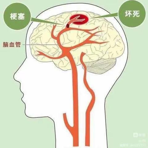 脑梗塞的护理你知道吗?