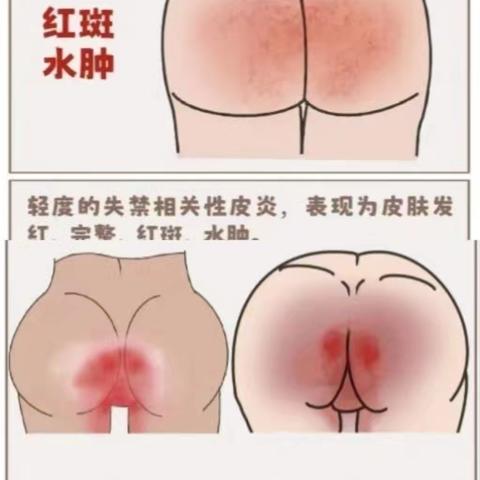 夏日炎炎，处“便”不惊—失禁性皮炎皮肤护理篇