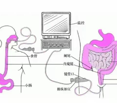 小肠镜解决“大”问题！上饶市立医院成功开展首例小肠镜术