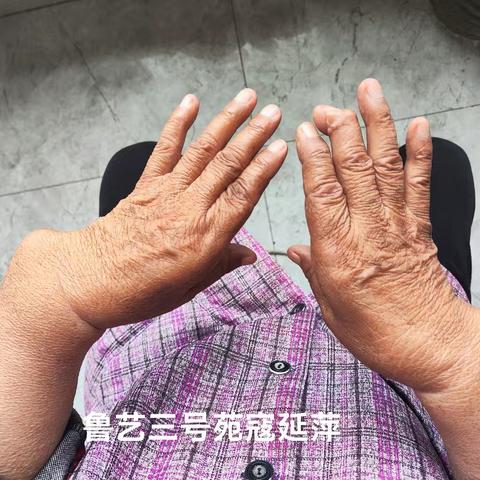 地方病大骨节病上门复核工作纪实