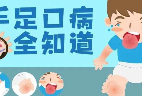 【卫生保健】“预防手足口、健康我先行”——百灵幼儿园手足口病预防知识