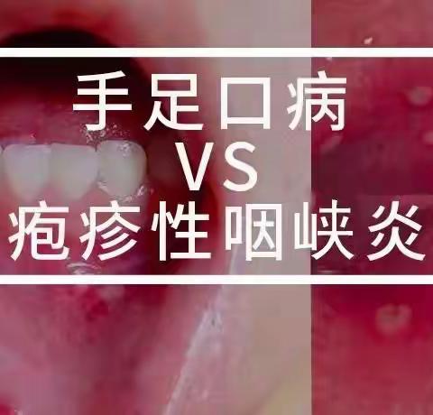 手足口VS疱疹性咽峡炎