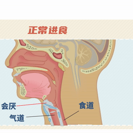 吞咽障碍，神经内科隐匿杀手