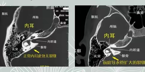 南石医院眩晕、脑病科（神经内科七病区）周围性眩晕——张荣钰医师科普（四十五）