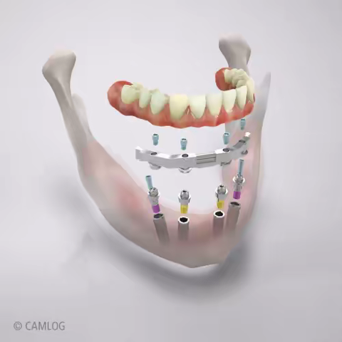 种植体有必要选贵的吗？1分钟看懂种植体品牌选择攻略！