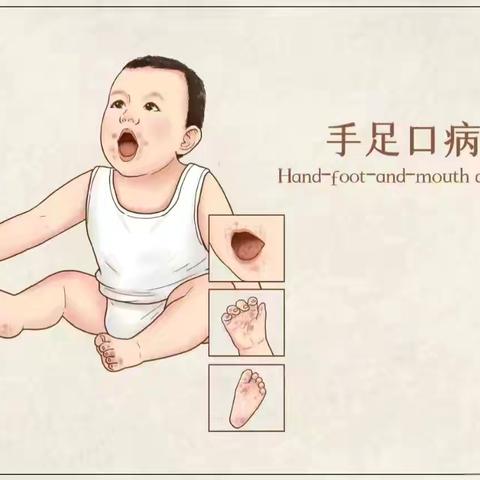 预防手足口病，关爱幼儿成长——启智幼儿园手足口病宣传知识