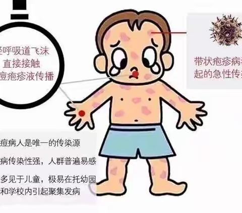 健康无“痘”——药惠中心幼儿园预防水痘知识宣传