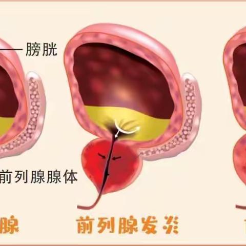 世上本无前列腺炎，无非是河道堵了而已