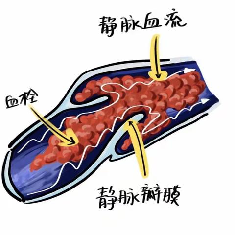 安静的健康杀手——深静脉血栓