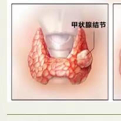 揭开甲状腺结节的“神秘面纱”