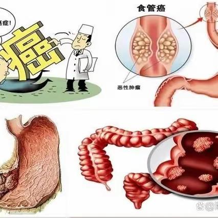 早发现消化道癌，告别癌症恐惧