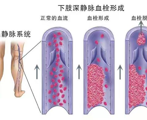 沉默的杀手—深静脉血栓