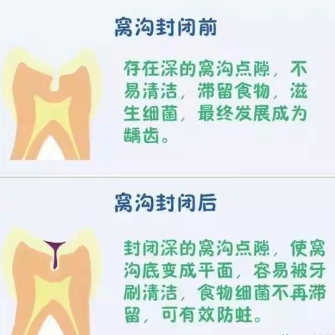 汇丰学校适龄儿童进行“窝沟封闭”