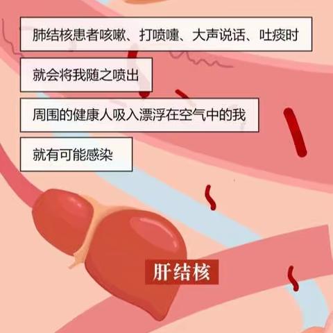 3.24结核病的防治