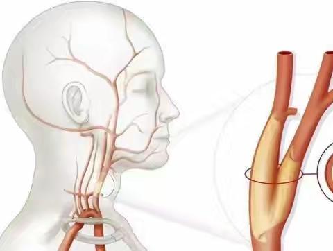 容易被忽视的颈动脉斑块 --血管斑块得“管”！