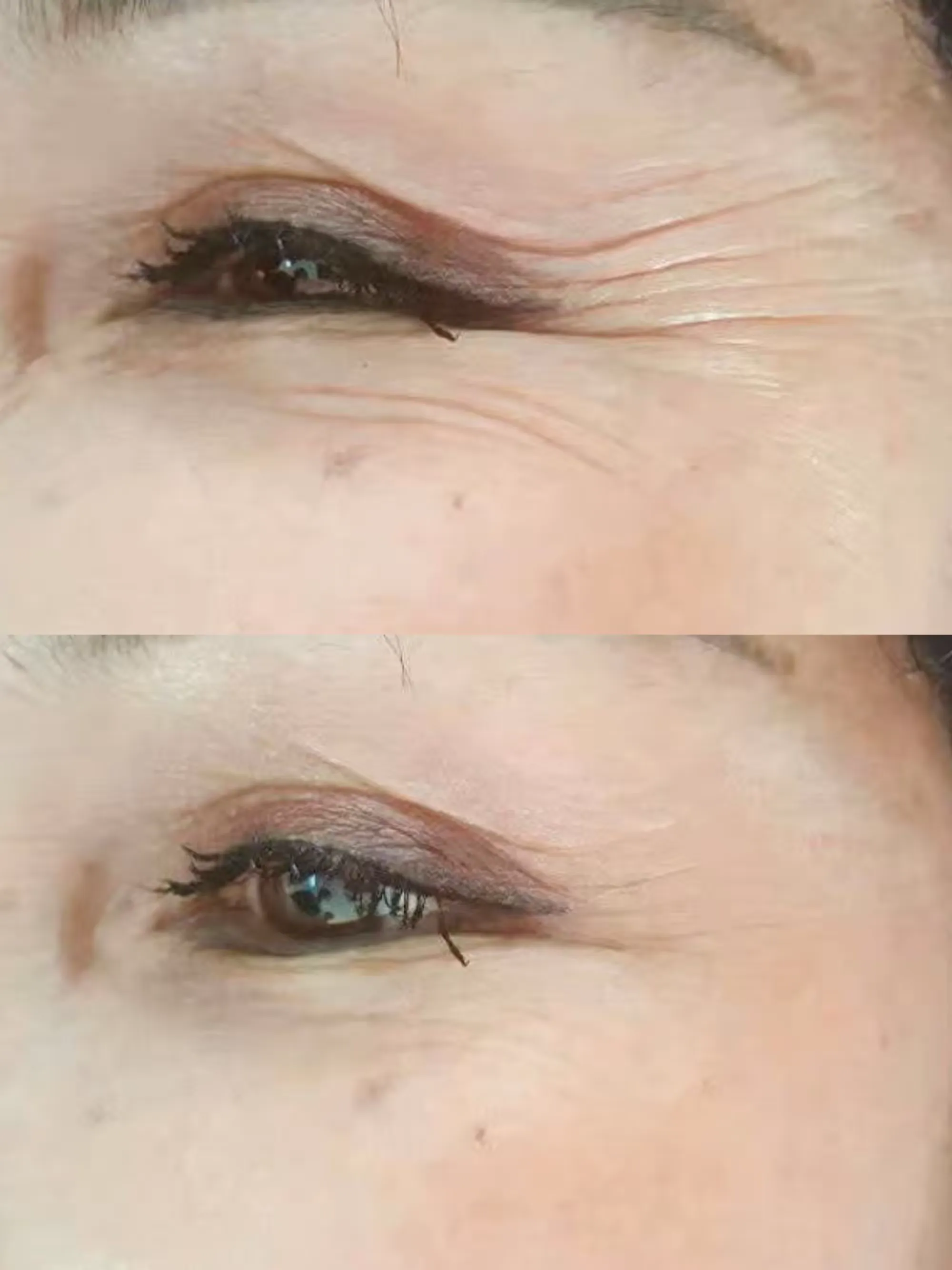 针灸祛鱼尾纹中医美容抗衰技术