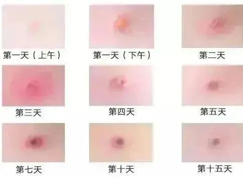 育儿有方／横栏华艺幼儿园—“知水痘，防水痘”——预防水痘知识宣传