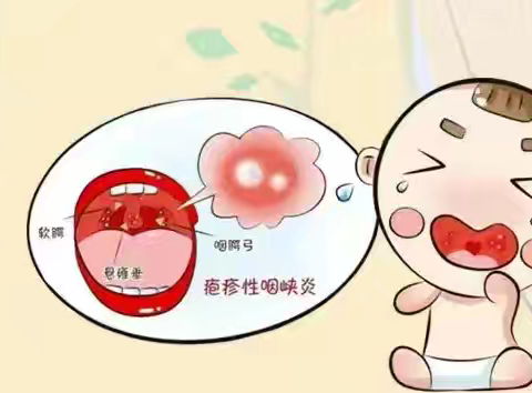 春夏季流感病毒预防工作—疱疹型咽颊炎 和手足口病