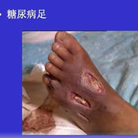 【宁夏中西医结合医院内分泌科】如何预防糖尿病足