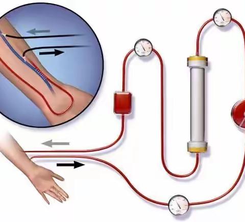 血液透析之“血流量”之谜