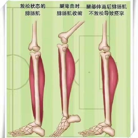 血液透析常见并发症之肌肉痉挛