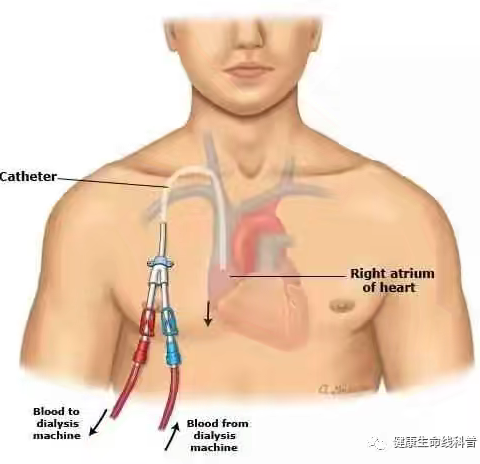 血液透析导管居家维护护理要点