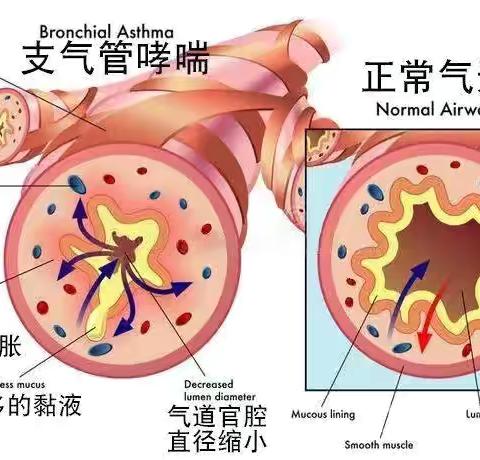 哮喘的长期控制与急性发作管理