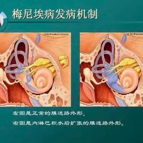 反复发作性眩晕伴听力下降？揭秘眩晕真凶之一——梅尼埃病！