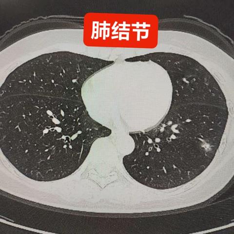 肺结节检查那些事