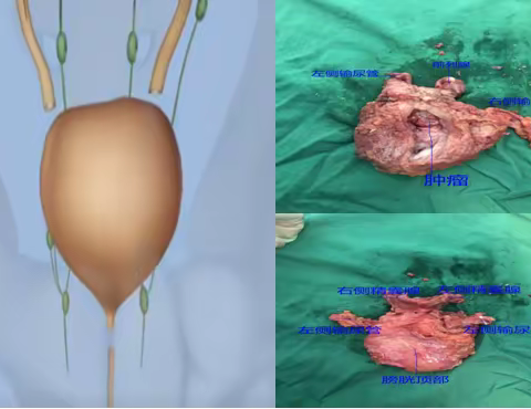 精益求精-腹腔镜下膀胱癌根治、回肠代膀胱腹壁造口术